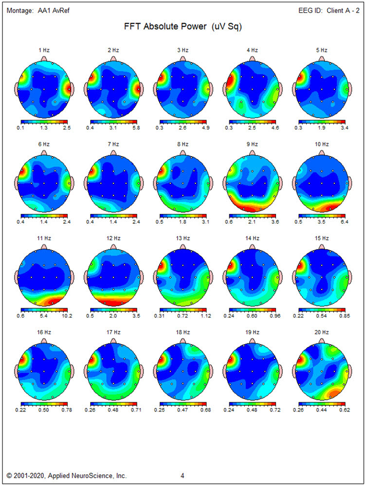 Second recording FFT absolute power maps showing bilateral posterior rhythm distribution
